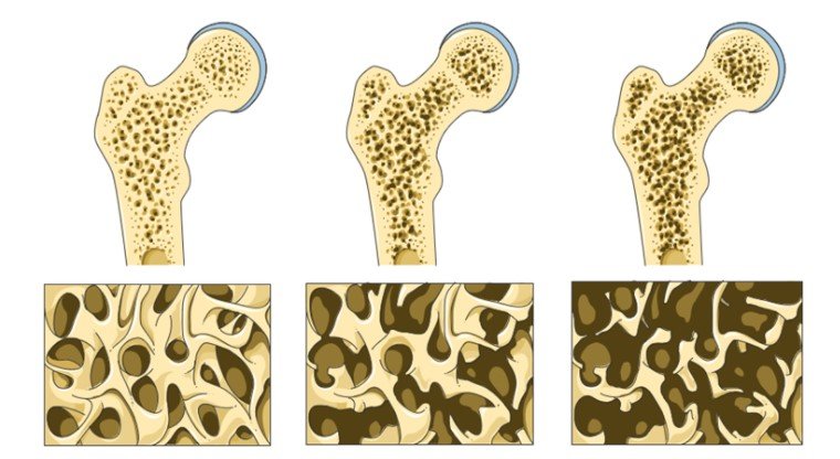 Parathyroidectomy and Osteoporosis- It Makes a Difference ...